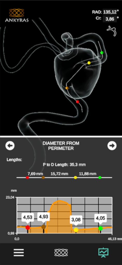 Ankyras - Medical visualization of vessel morphology and diameter graph for surgical planning in the Ankyras app.