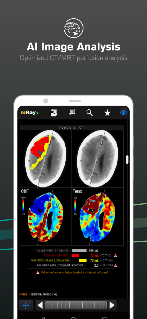 Interface de l'application mRay affichant une analyse de perfusion cérébrale assistée par IA avec des cartes thermiques codées par couleur et des métriques cliniques.