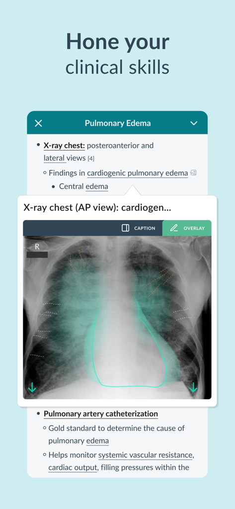 Application médicale AMBOSS montrant une radiographie pulmonaire avec une superposition d'image diagnostique pour un œdème pulmonaire.