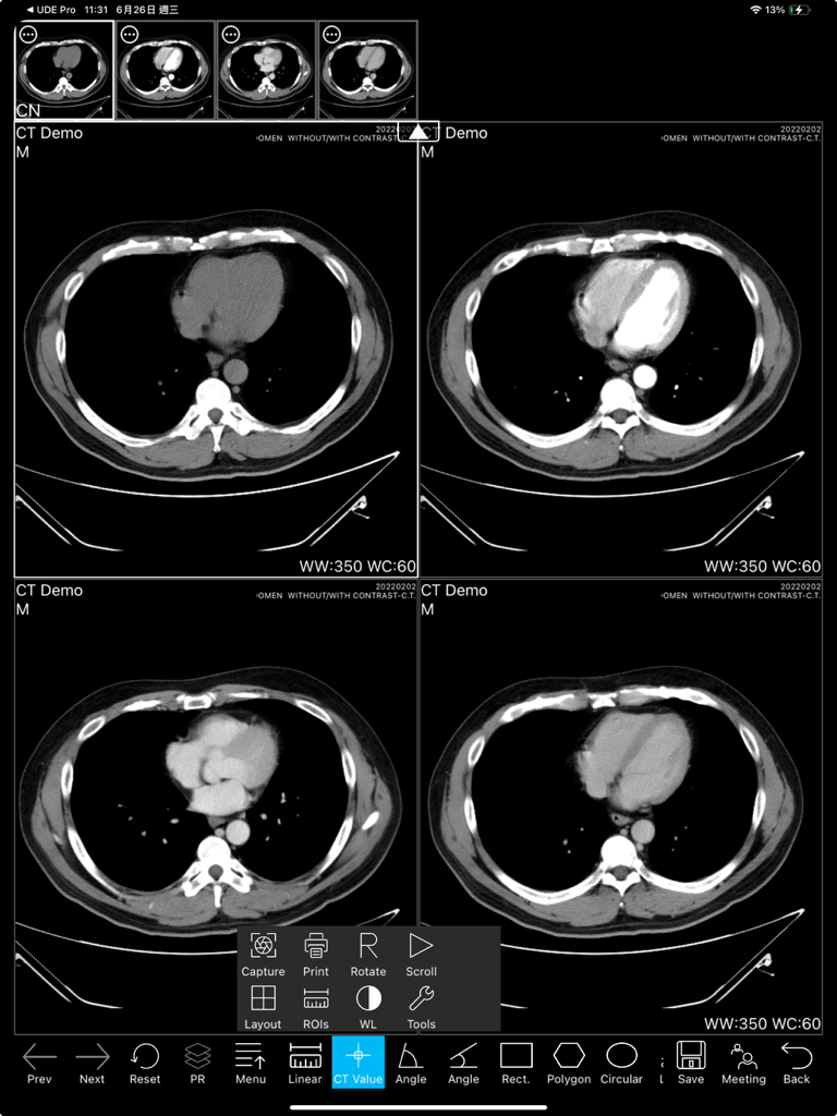 UDE Lite app interface displaying a four-quadrant layout of chest CT scan images with a toolbar and medical measurement tools
